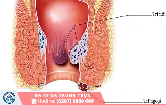 Trĩ là nguyên nhân phổ biến gây nên tình trạng đi cầu ra máu 