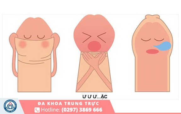 Viêm bao quy đầu phần lớn là do bị dài hoặc hẹp da bao quy đầu