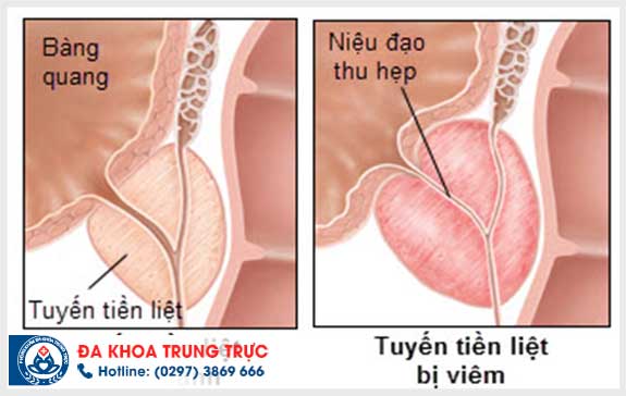 dau tinh hoan trai la dau hieu cua benh gi