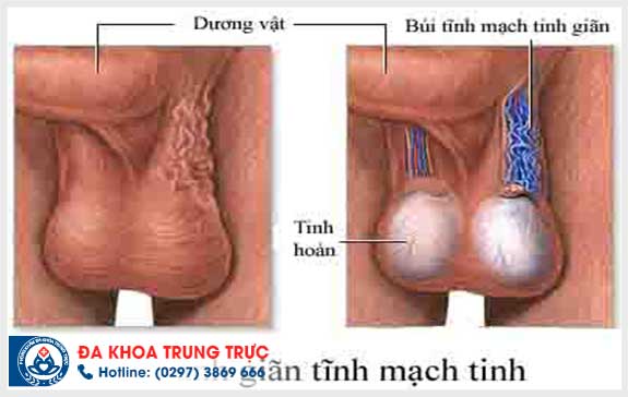 tinh hoan trai bị dau la dau hieu cua benh ly nao