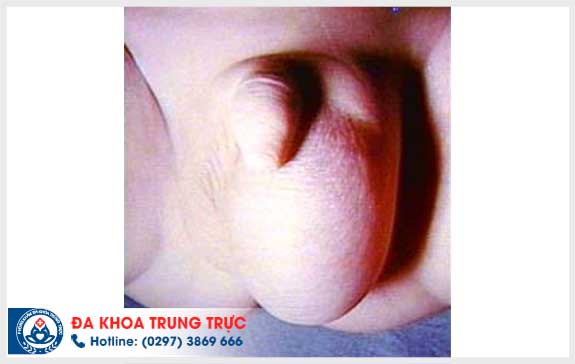 nguyen nhan gay tran dich mang tinh hoan