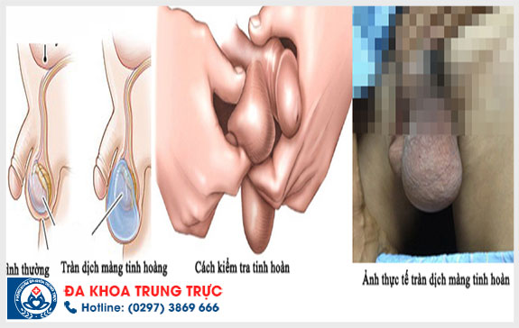 nguyen nhan gay tran dich mang tinh hoan