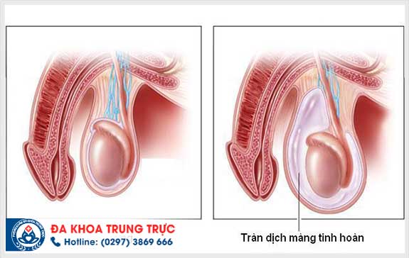 dau hieu tran dich mang tinh hoan o nam gioi