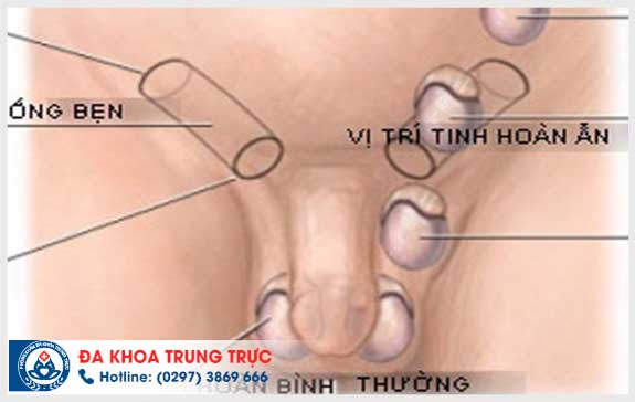 nguyen nhan gay xoan tinh hoan la gi