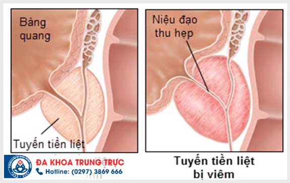 tac hai viem duong tiet nieu doi voi nam gioi