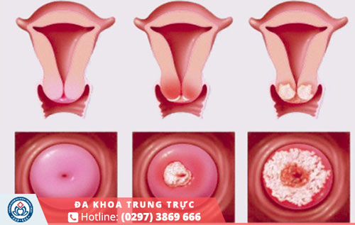 Việc không chữa trị sẽ khiến tử cung bị viêm loét và nhiễm trùng trầm trọng