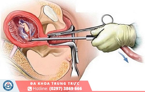 Đình chỉ thai không phải là một thủ thuật đơn giản 