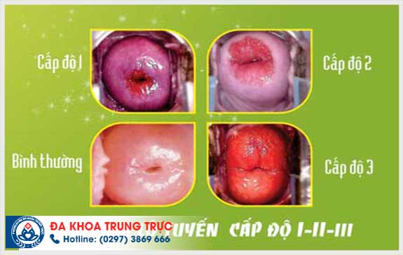 truong hop khong nen dat vong tranh thai