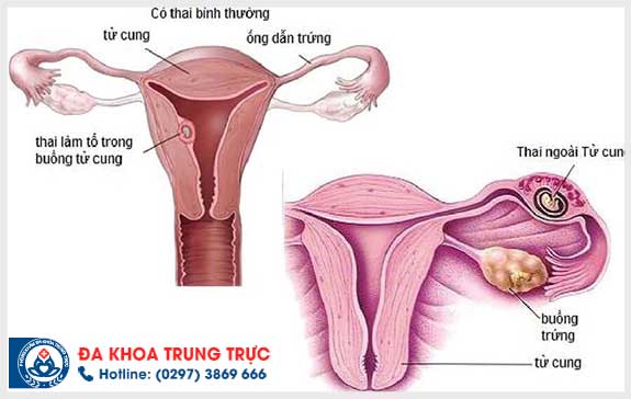 mang thai ngoai tu cung phai lam sao