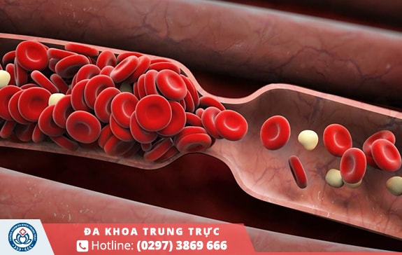 Quá trình lưu thông máu bị ảnh hưởng gây ra các cơn co thắt