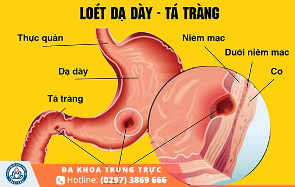 Loét dạ dày