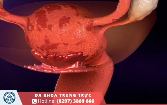 Lạc nội mạc tử cung chiếm tỷ lệ cao gây nên đau bụng kinh