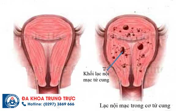 polyp co tu cung do nhung nguyen nhan nao