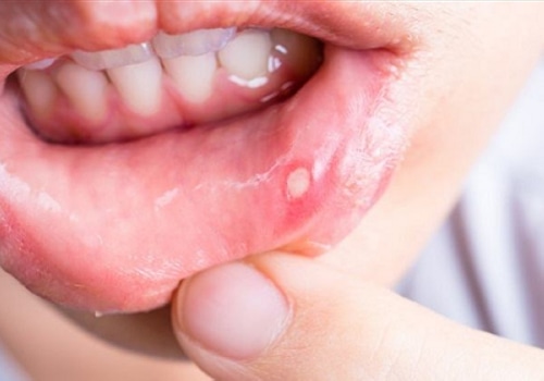 [Lưu Ý] 6 Dấu hiệu nhiễm HPV ở miệng mà bạn nên biết